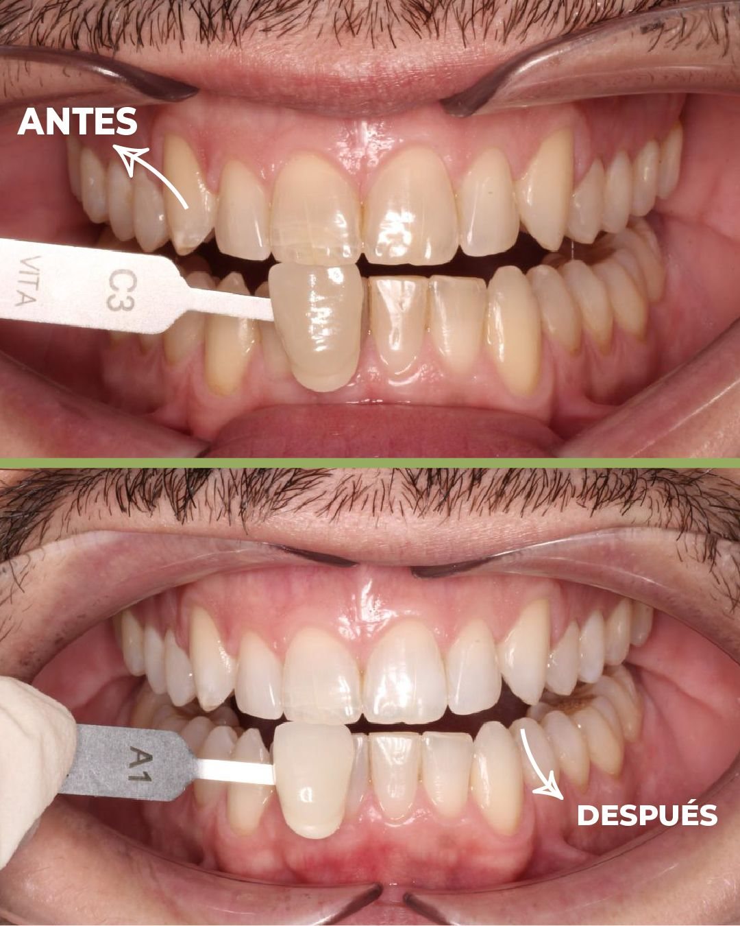 Blanqueamiento dental: antes y después en un paciente real de la clínica
