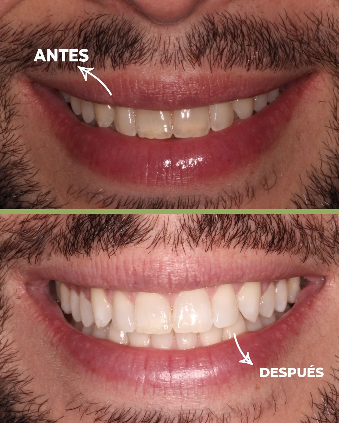 Blanqueamiento dental antes y después, caso real 2