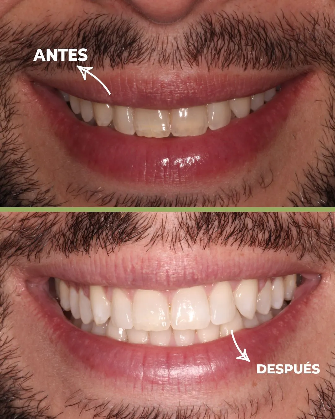 Blanqueamiento dental · mismo protocolo, otra boca