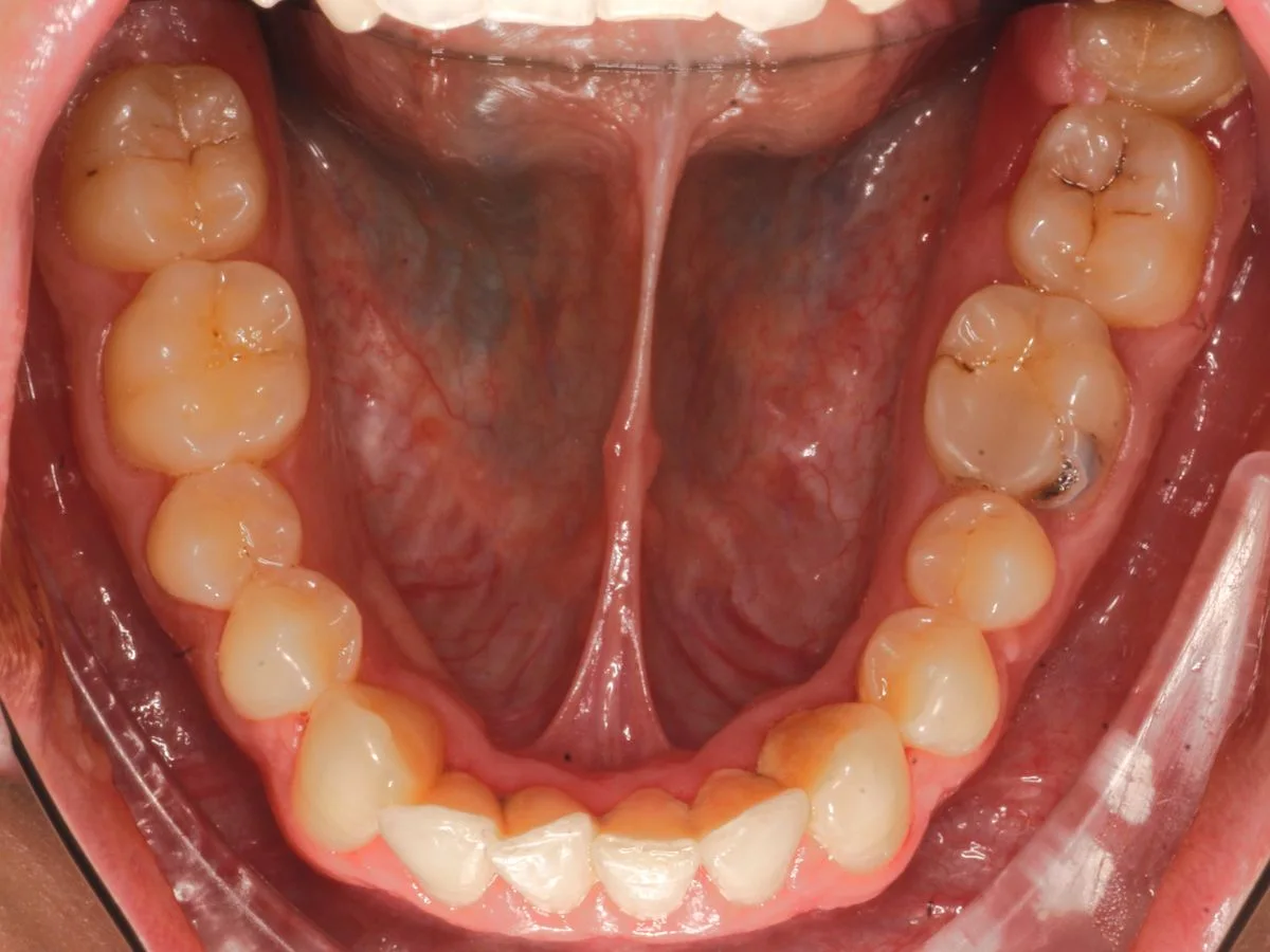 Odontología conservadora, caso real: muelas con caries antes del tratamiento