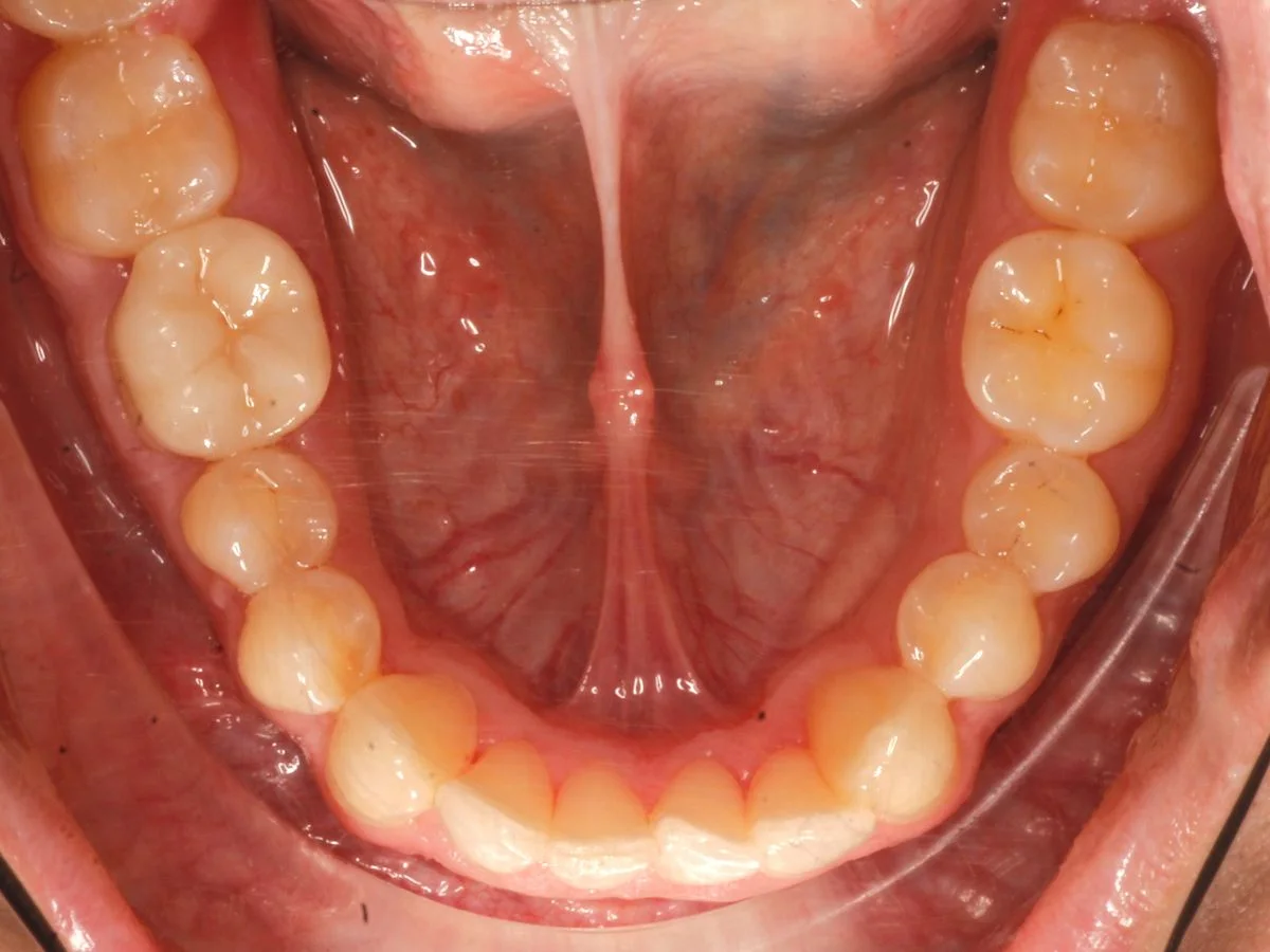Odontología conservadora, caso real: muelas restauradas con empastes del color del diente