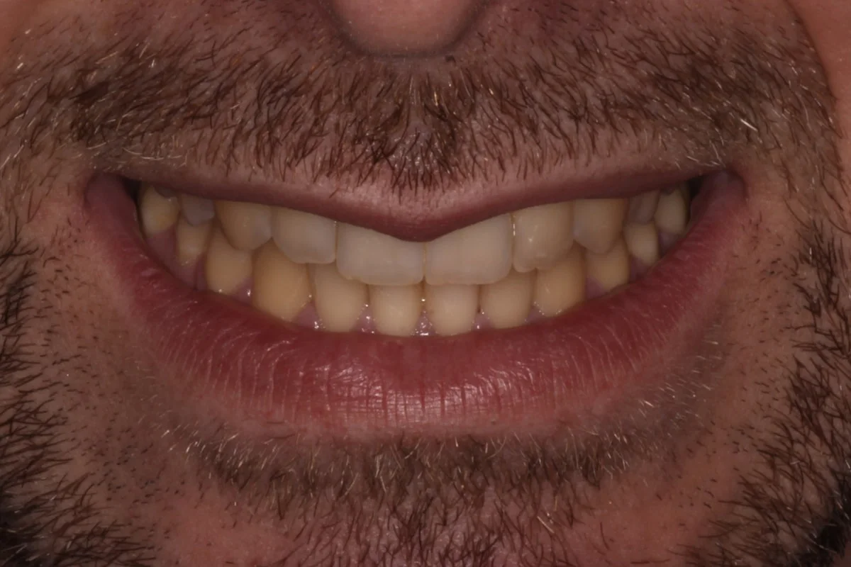 Blanqueamiento dental, caso real 3: tono de partida