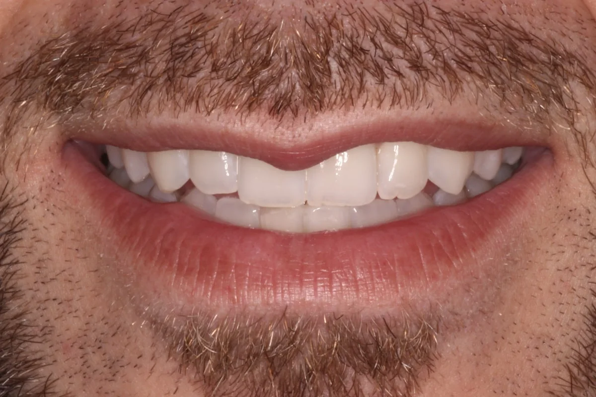 Blanqueamiento dental, caso real 3: resultado final