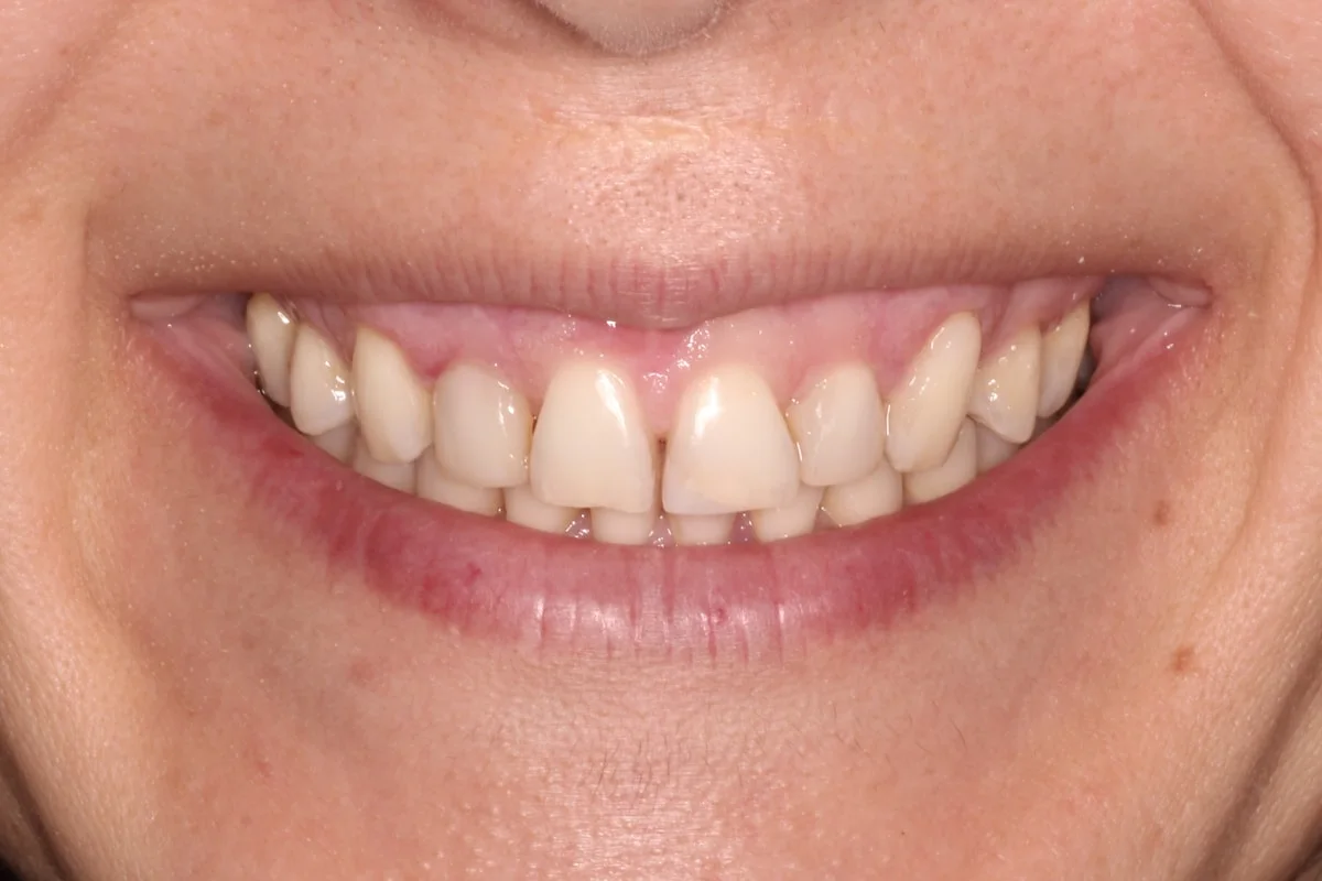 Carillas dentales, caso real: sonrisa antes del tratamiento