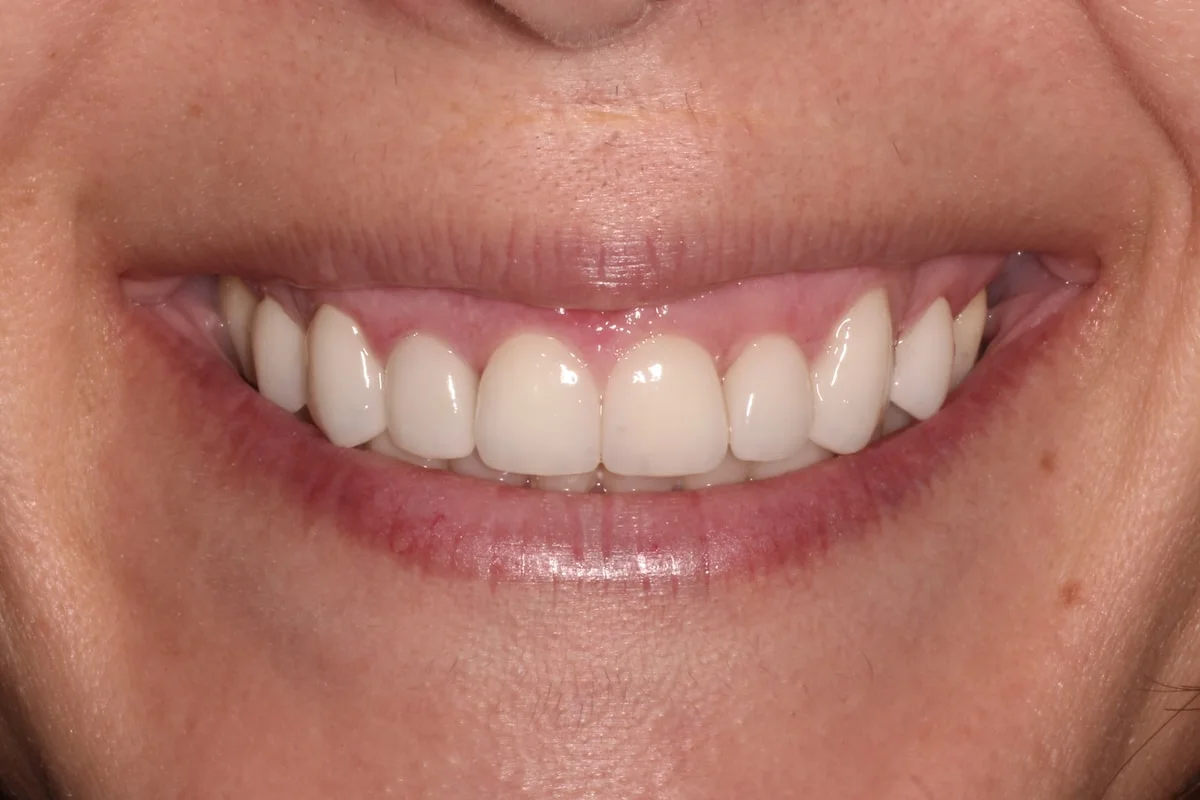 Carillas dentales, caso real: sonrisa armonizada después del tratamiento