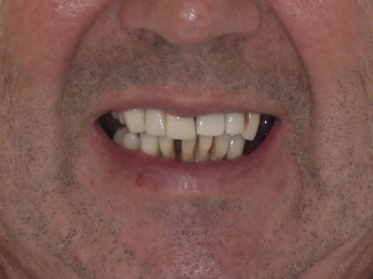Fundas antiguas y enfermedad periodontal → rehabilitación natural — antes