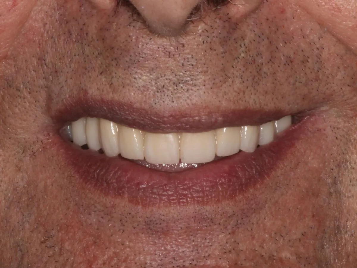 Después: Edéntulo total → prótesis fija de zirconio sobre implantes