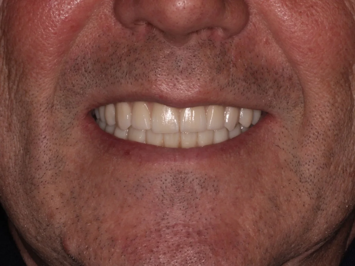 Después: Fundas antiguas y enfermedad periodontal → rehabilitación natural