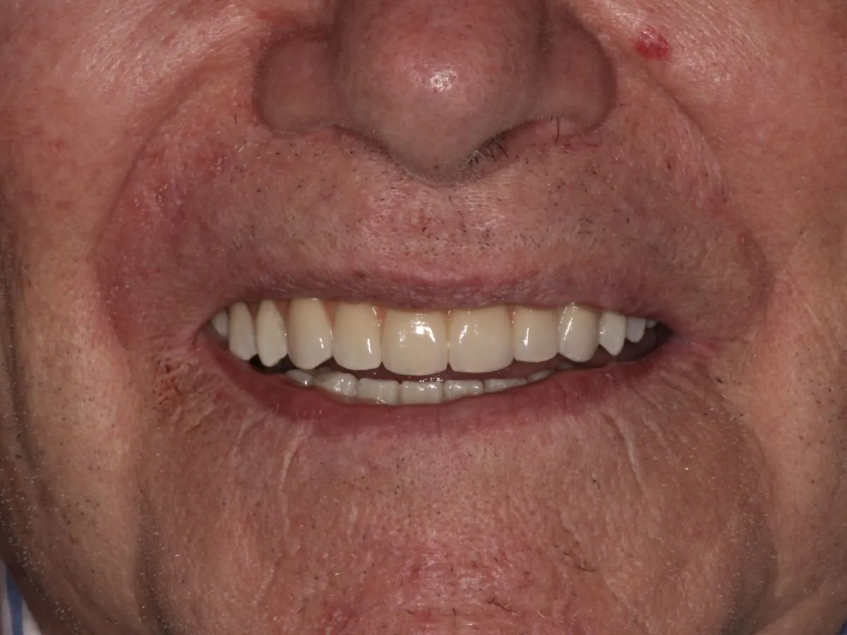 Dientes muy deteriorados → sonrisa completa fija — resultado