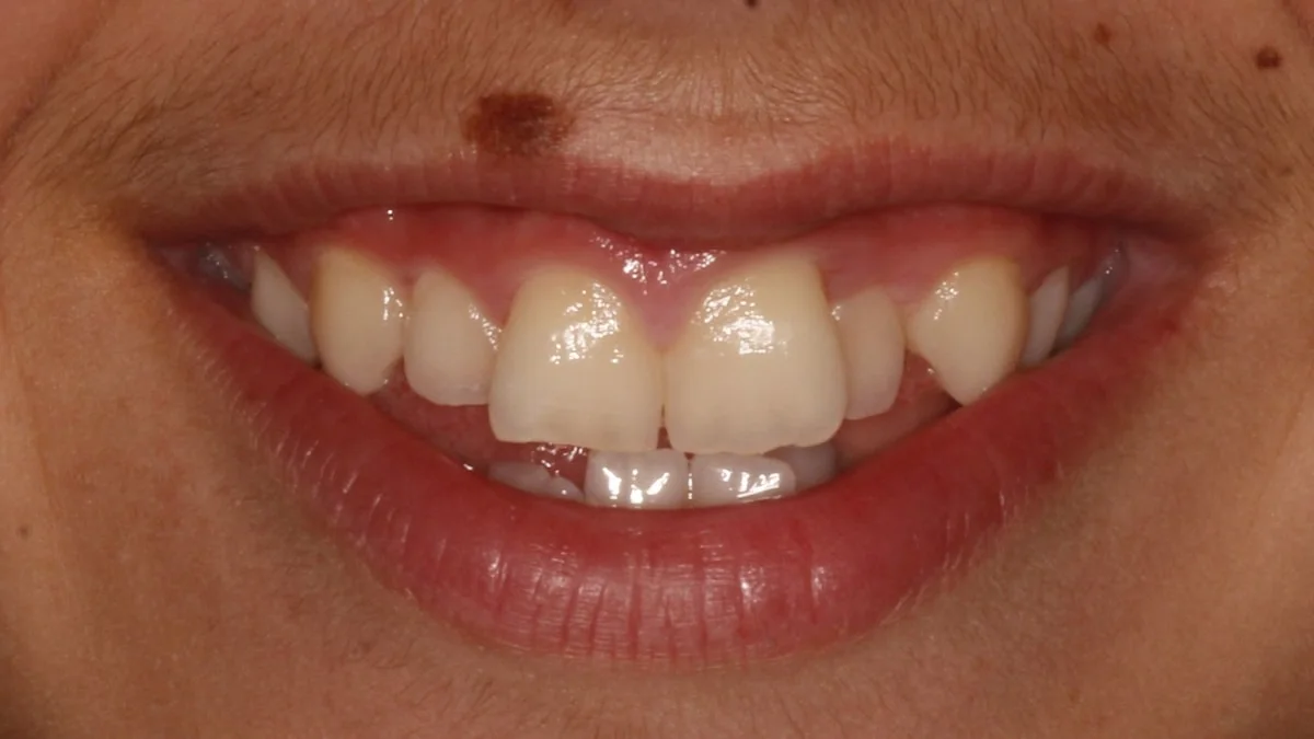 Ortodoncia invisible, caso real 1: sonrisa con dientes apiñados antes del tratamiento