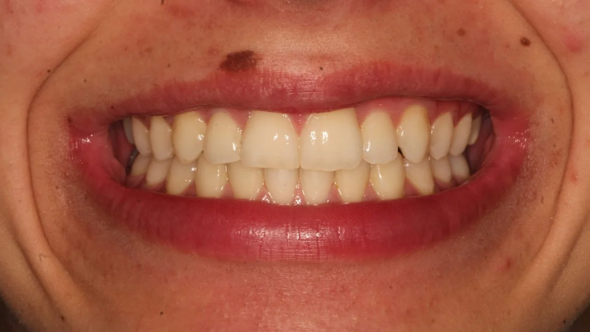 Ortodoncia invisible, caso real 1: sonrisa alineada al terminar el tratamiento