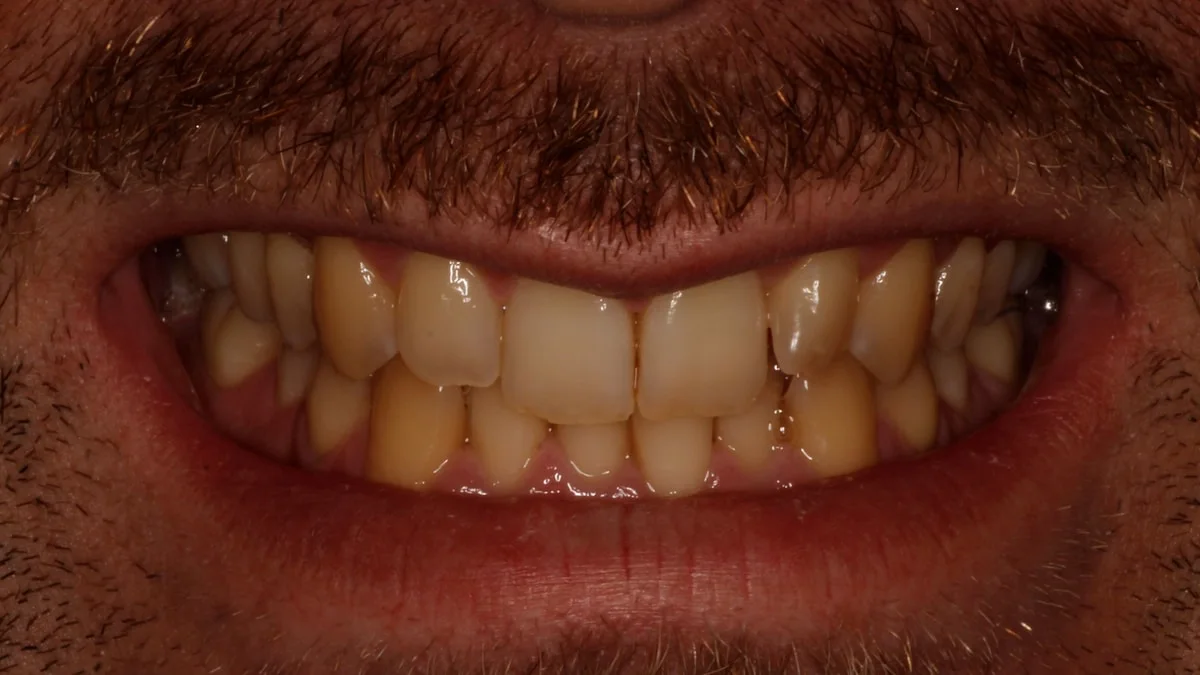 Ortodoncia invisible y blanqueamiento, caso real 2: sonrisa antes del tratamiento