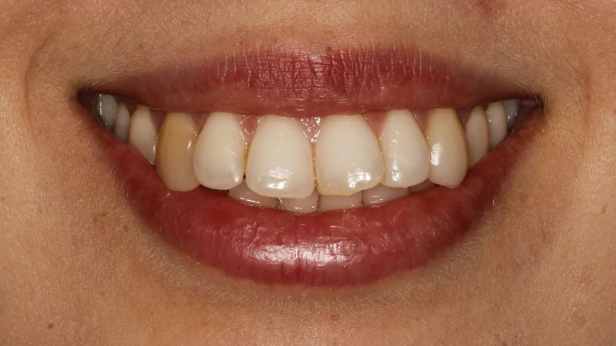 Ortodoncia invisible y blanqueamiento, caso real 3: sonrisa antes del tratamiento
