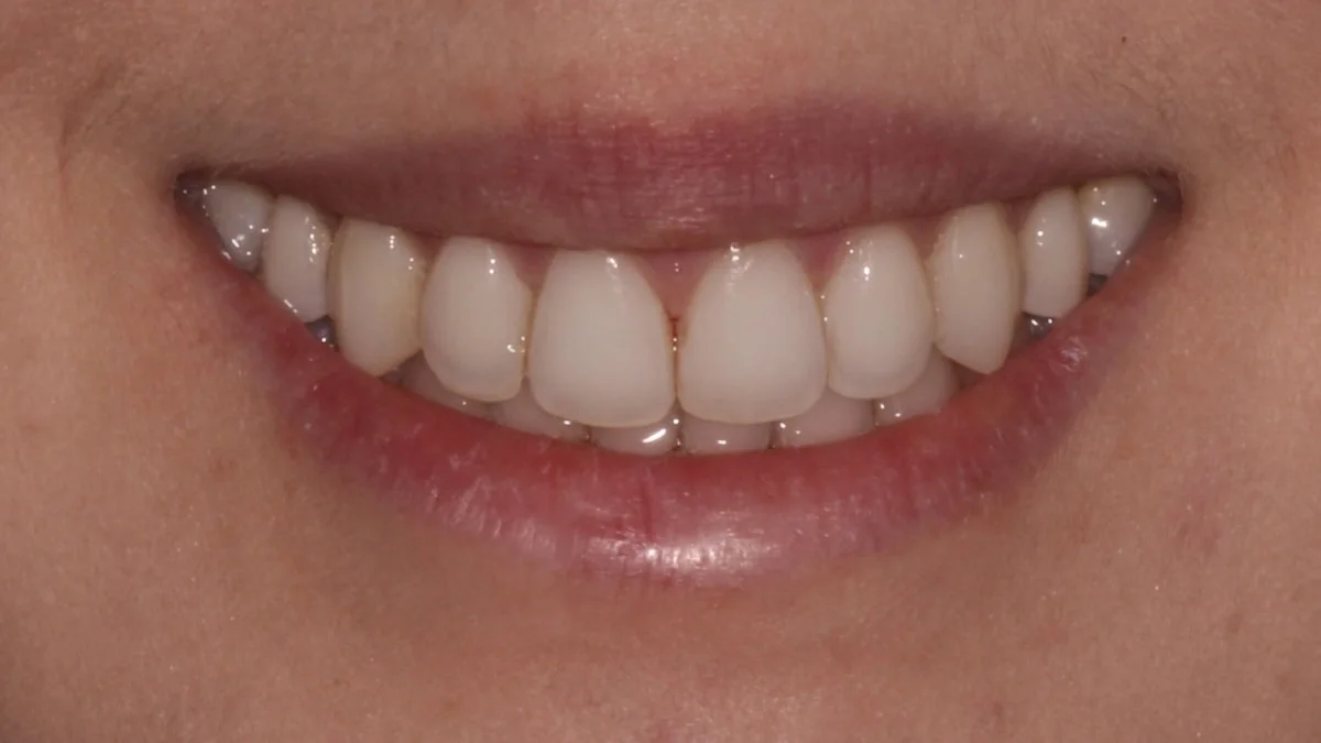 Ortodoncia invisible y blanqueamiento, caso real 3: sonrisa uniforme y más blanca