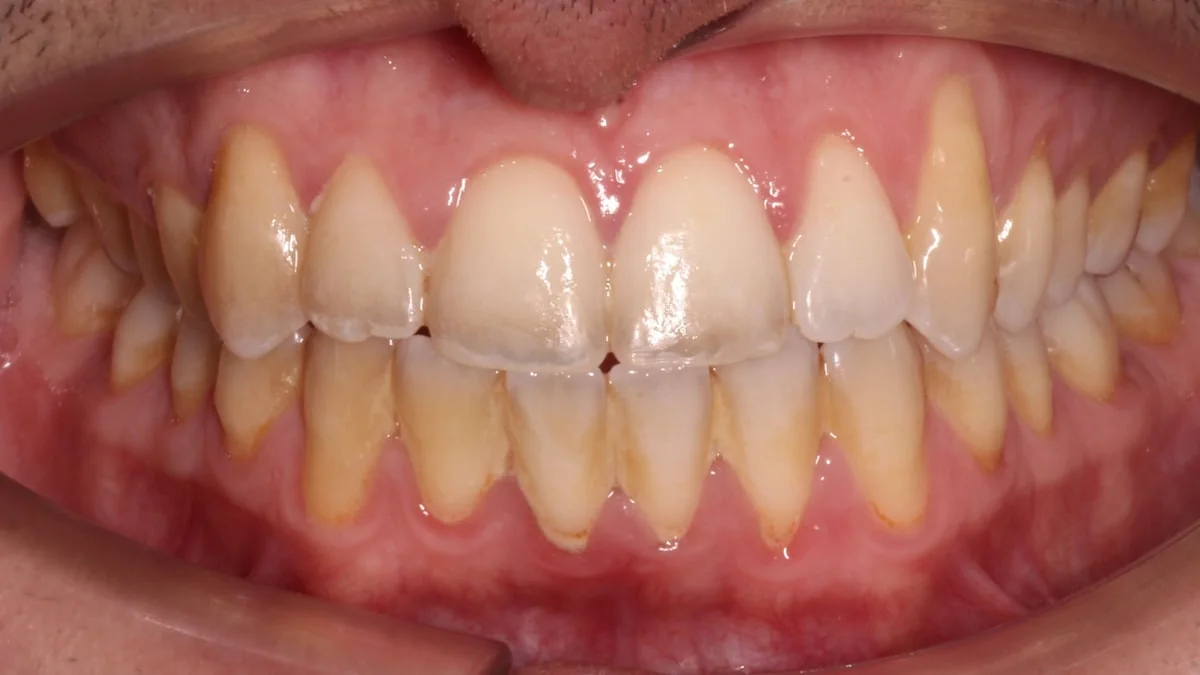 Higiene dental profesional, caso real: dientes con sarro y manchas antes de la limpieza