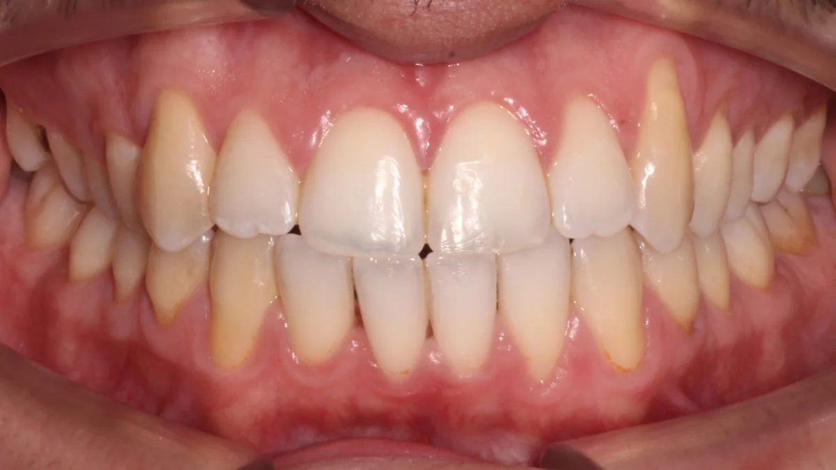 Higiene dental profesional, caso real: dientes limpios después de la limpieza