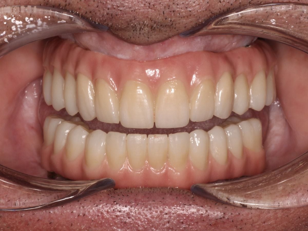 Prótesis fija completa sobre implantes: resultado de un paciente real